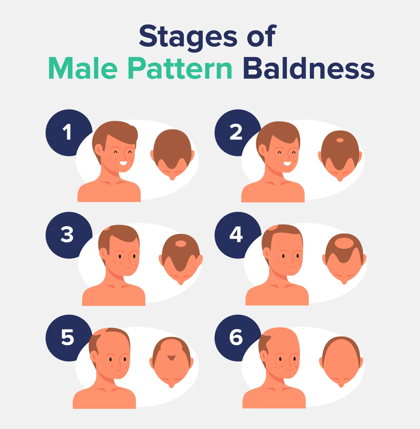 Stages of Male Pattern Baldness