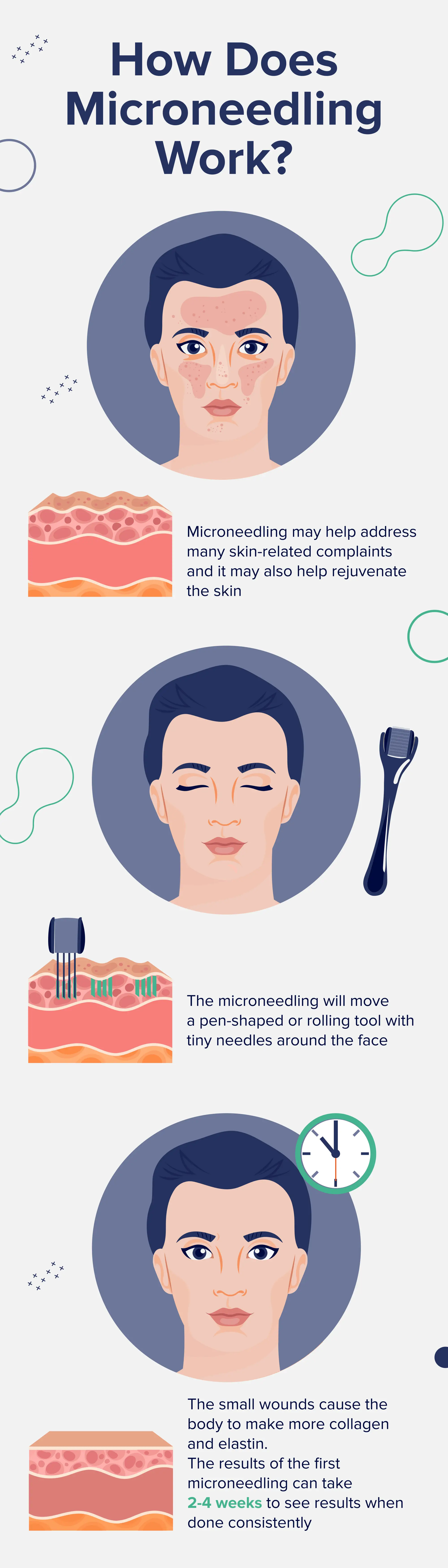 A visual guide to microneedling, showing its skin rejuvenation process.