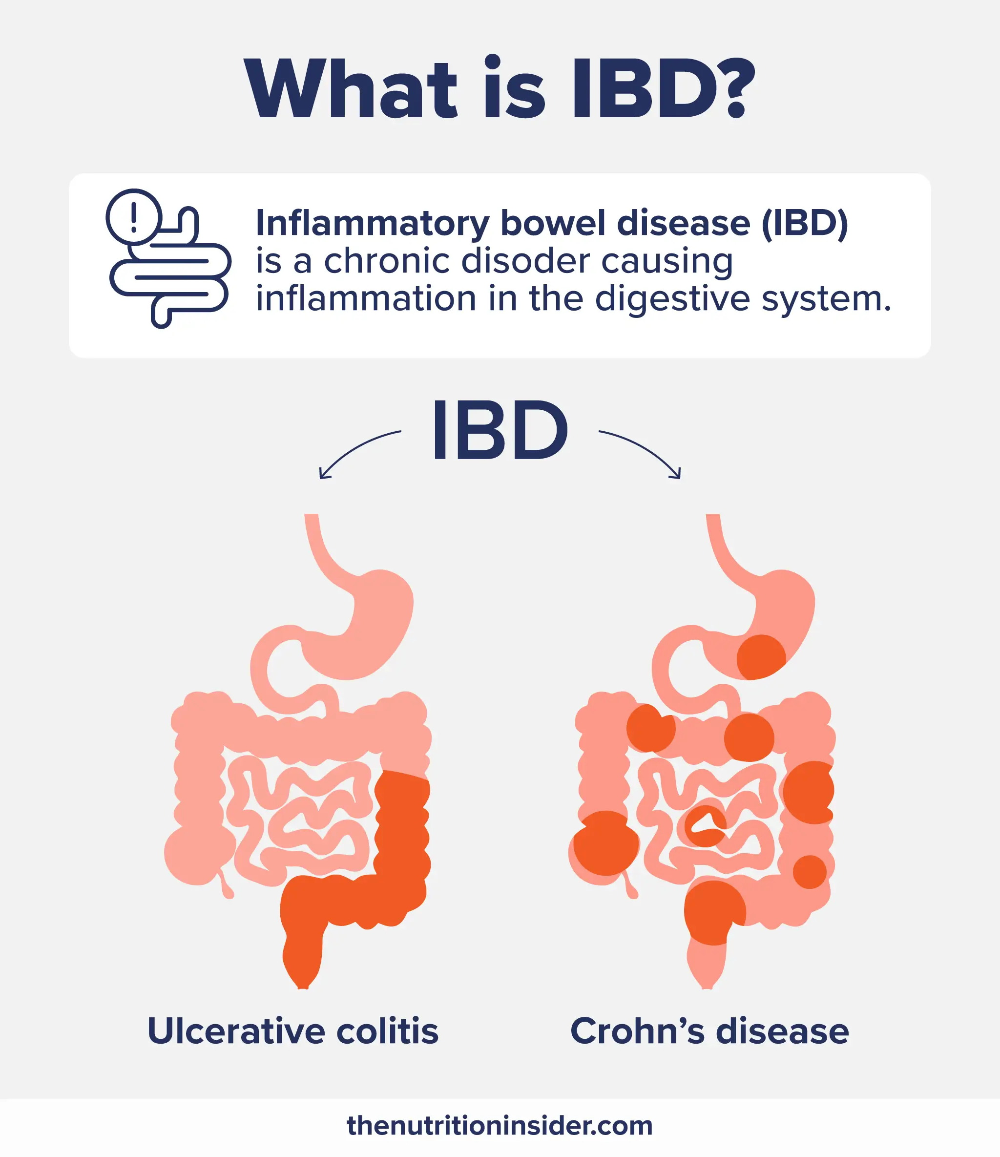 An infographic defining IBD and illustrating the difference between ulcerative colitis and Crohn's disease.